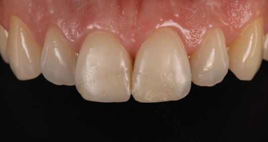 Esthetic replacement of anterior class IV restorations
