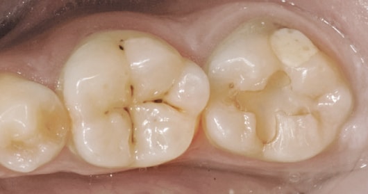 Esthetic replacement of two restorations on mandibular second molar
